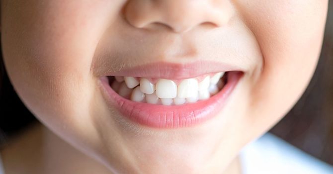 How to Stop Kids from Grinding Teeth: A Myofunctional Therapy Solution