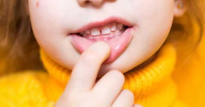Can Myofunctional Therapy Help Correct an Overbite?