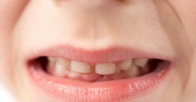 Can Tongue Thrust Be a Sign of Airway Dysfunction?
